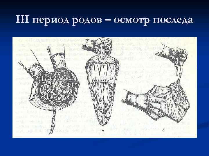 III период родов – осмотр последа 