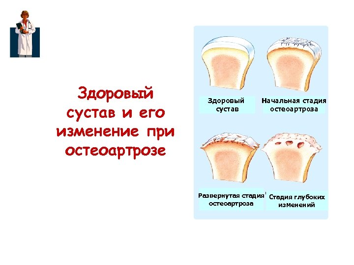 Деформирующий остеоартроз это. Стадии при остеоартрозе. Здоровый сустав и остеоартроз. Изменения суставов при остеоартрозе.