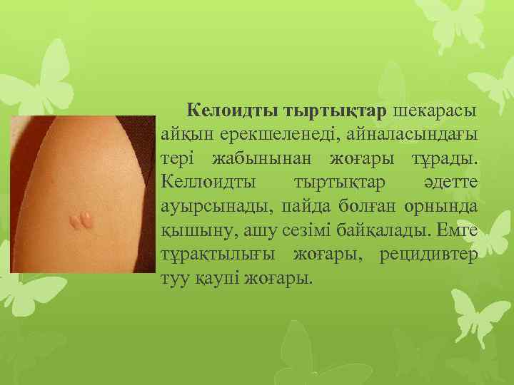 Келоидты тыртықтар шекарасы айқын ерекшеленеді, айналасындағы тері жабынынан жоғары тұрады. Келлоидты тыртықтар әдетте ауырсынады,