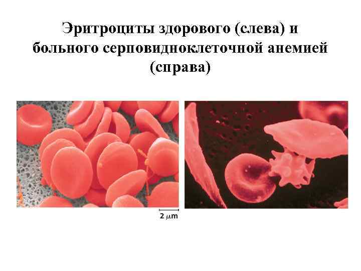 Эритроциты здорового (слева) и больного серповидноклеточной анемией (справа) 