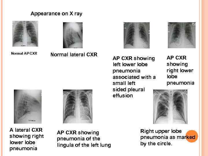 Appearance on X ray Normal AP CXR A lateral CXR showing right lower lobe