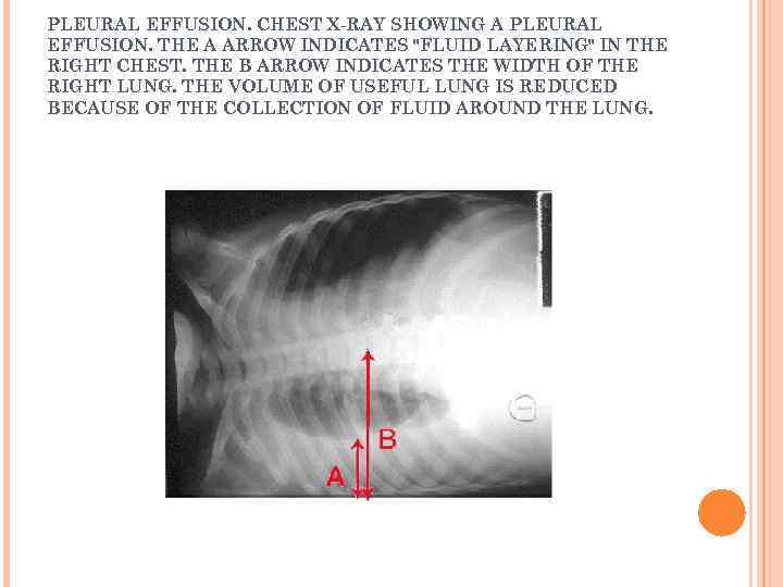 PLEURAL EFFUSION. CHEST X-RAY SHOWING A PLEURAL EFFUSION. THE A ARROW INDICATES "FLUID LAYERING"