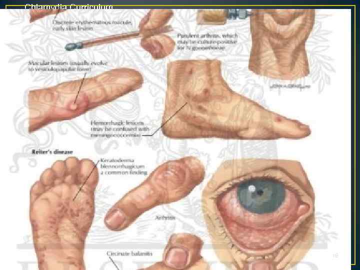 Chlamydia Curriculum 18 