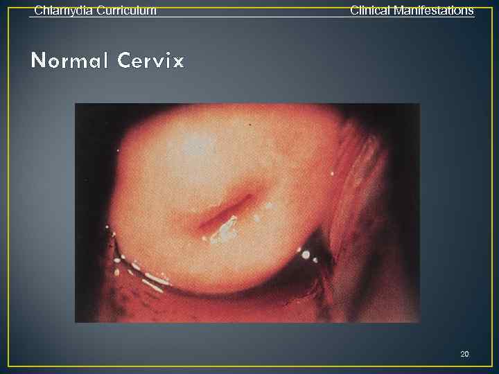 Chlamydia Curriculum Clinical Manifestations Normal Cervix 20 