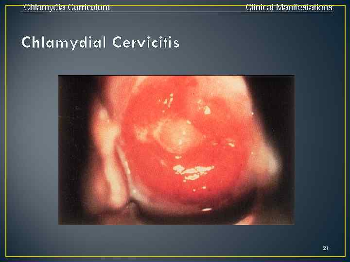 Chlamydia Curriculum Clinical Manifestations Chlamydial Cervicitis 21 