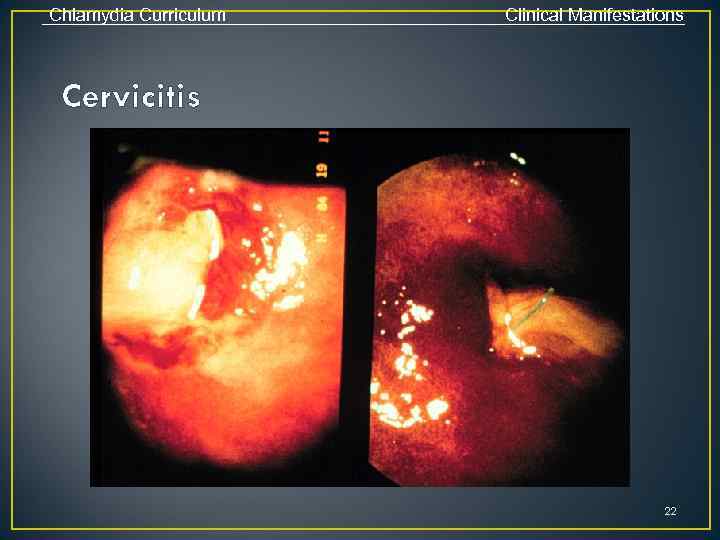 Chlamydia Curriculum Clinical Manifestations Cervicitis 22 