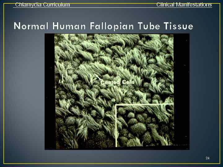 Chlamydia Curriculum Clinical Manifestations Normal Human Fallopian Tube Tissue 24 