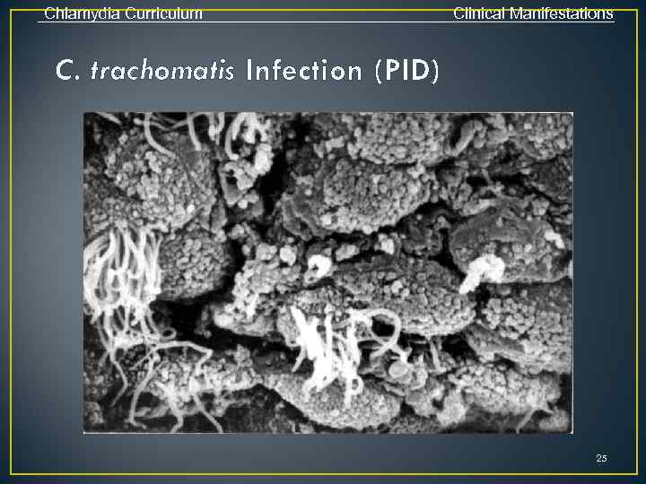 Chlamydia Curriculum Clinical Manifestations C. trachomatis Infection (PID) 25 