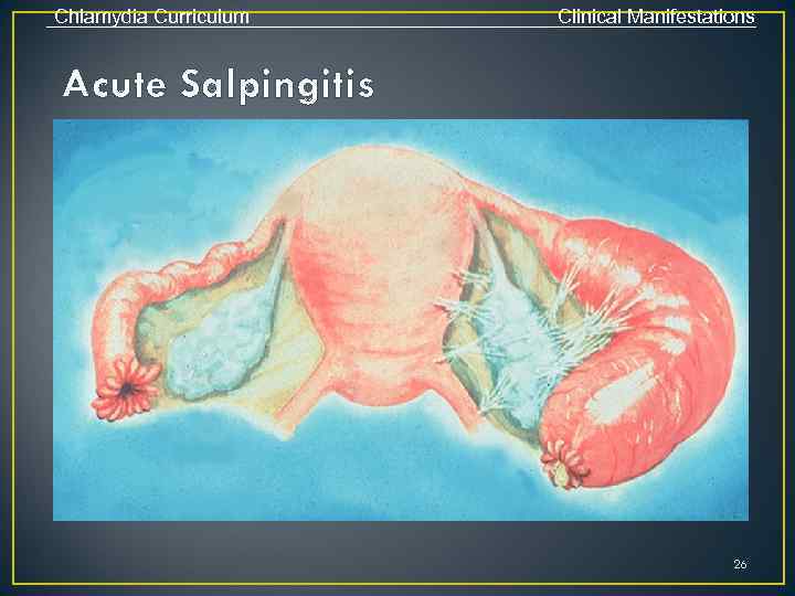 Chlamydia Curriculum Clinical Manifestations Acute Salpingitis 26 
