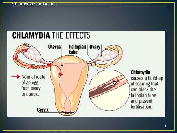 Chlamydia Curriculum 4 