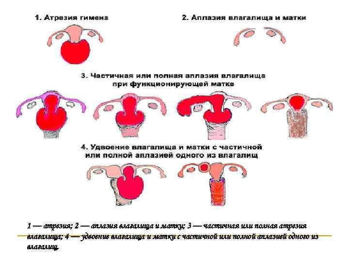 1 — атрезия; 2 — аплазия влагалища и матки; 3 — частичная или полная