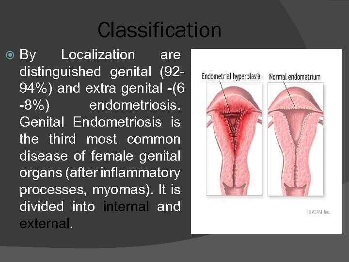 Classification By Localization are distinguished genital (9294%) and extra genital -(6 -8%) endometriosis. Genital