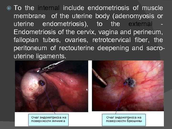  To the internal include endometriosis of muscle membrane of the uterine body (adenomyosis