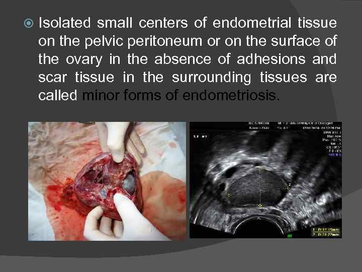  Isolated small centers of endometrial tissue on the pelvic peritoneum or on the