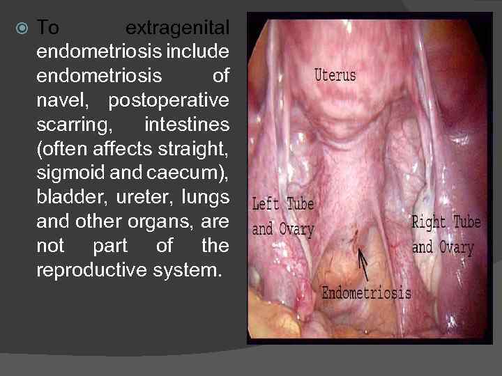  To extragenital endometriosis include endometriosis of navel, postoperative scarring, intestines (often affects straight,