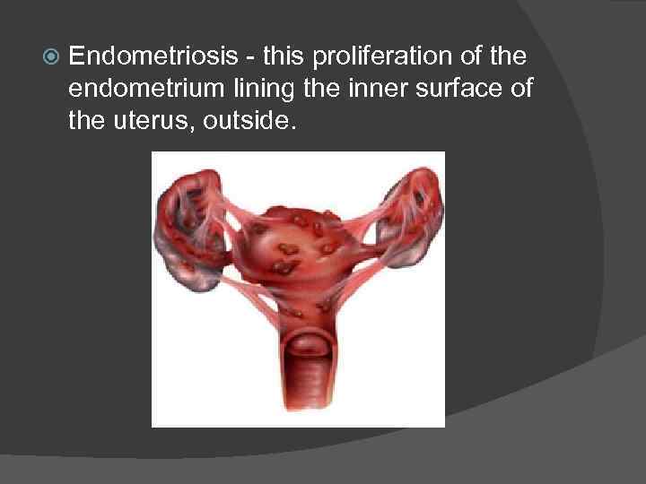  Endometriosis - this proliferation of the endometrium lining the inner surface of the