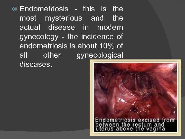  Endometriosis - this is the most mysterious and the actual disease in modern