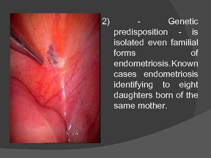 2) Genetic predisposition - is isolated even familial forms of endometriosis. Known cases endometriosis