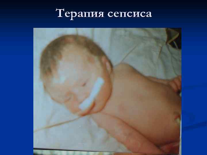 Терапия сепсиса 