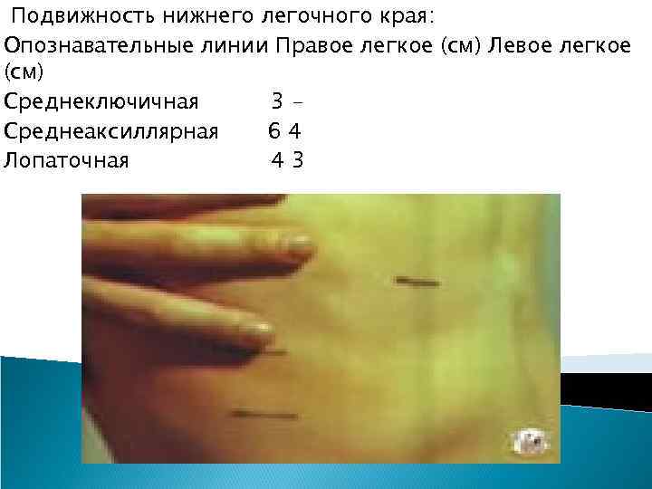 Подвижность нижнего легочного края: Опознавательные линии Правое легкое (см) Левое легкое (см) Среднеключичная 3