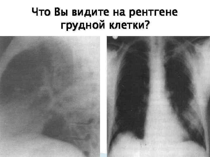 Что Вы видите на рентгене грудной клетки? 