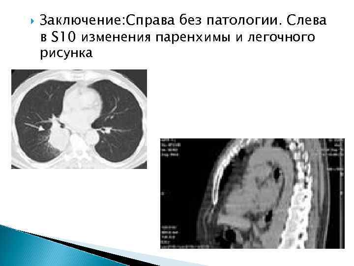 Заключение: Справа без патологии. Слева в S 10 изменения паренхимы и легочного рисунка