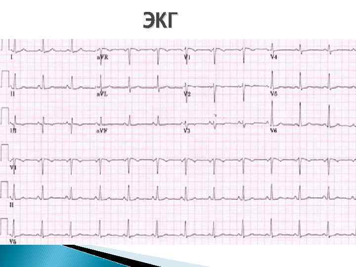 ЭКГ 