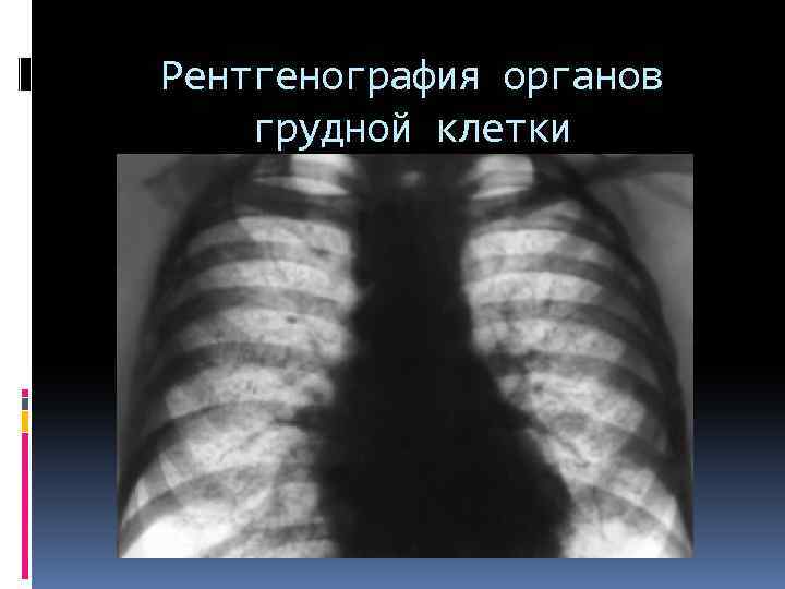Рентгенография органов грудной клетки 
