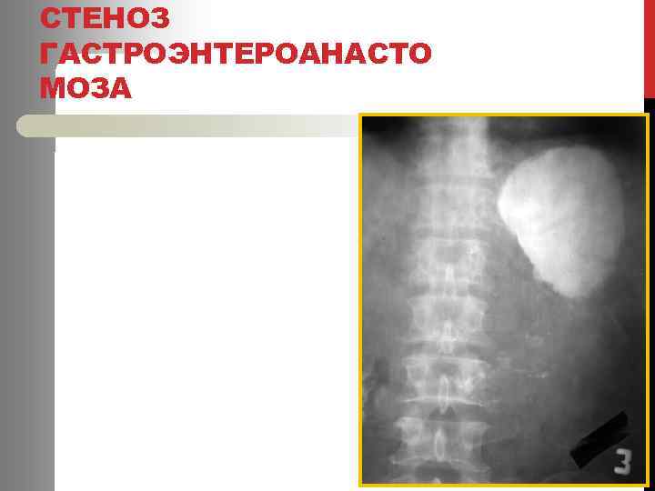 СТЕНОЗ ГАСТРОЭНТЕРОАНАСТО МОЗА 