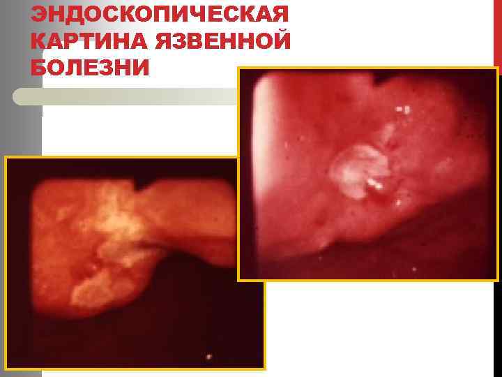 ЭНДОСКОПИЧЕСКАЯ КАРТИНА ЯЗВЕННОЙ БОЛЕЗНИ 