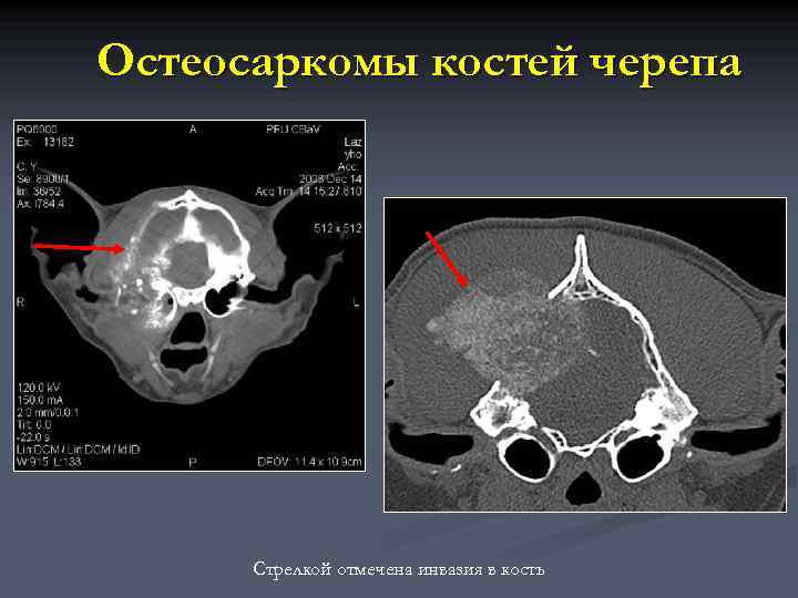 Кт картина краевой деструкции смежных костей наиболее характерна для