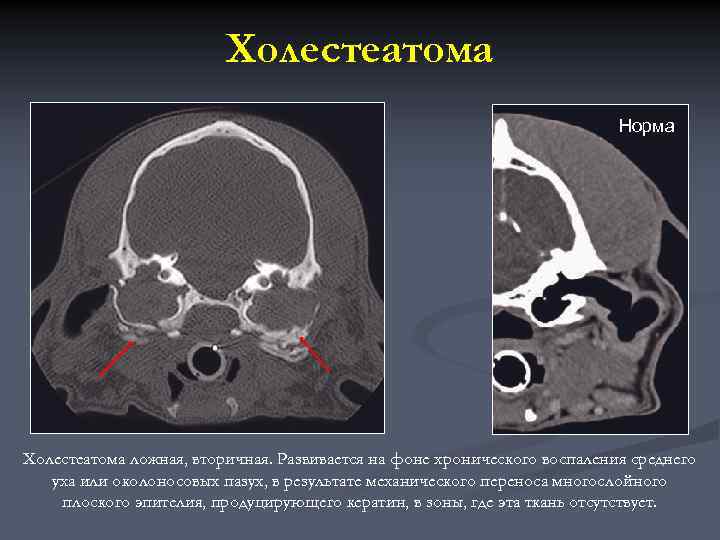 Холестеатома Норма Холестеатома ложная, вторичная. Развивается на фоне хронического воспаления среднего уха или околоносовых