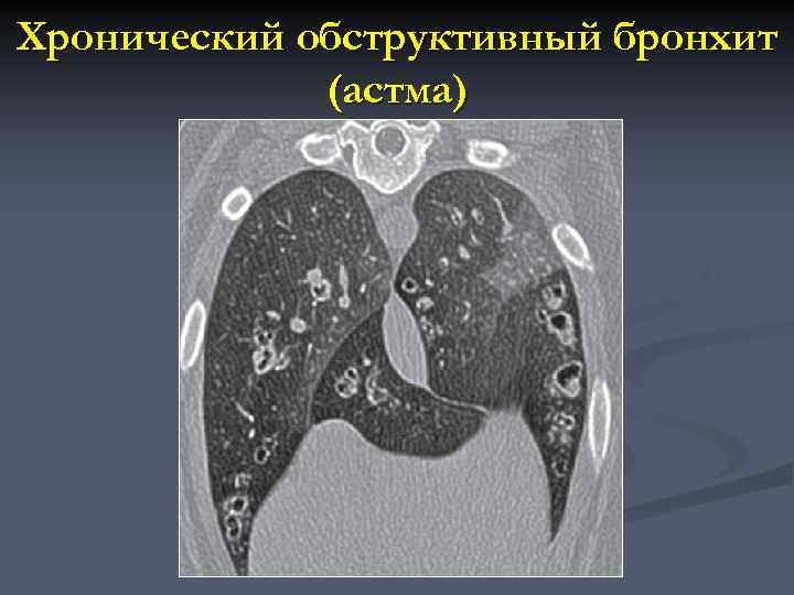 Хронический обструктивный бронхит (астма) 