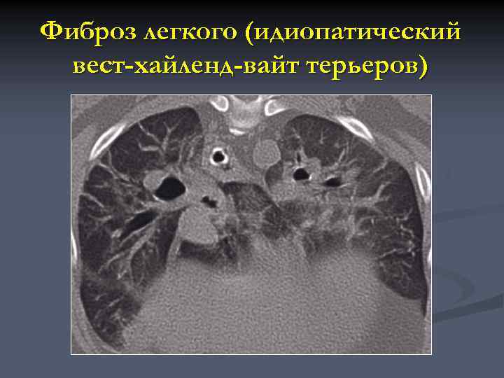 Фиброз в доле легкого. Идиопатический легочный фиброз кт. Идиопатический фиброз легких кт. Фиброз легкого на кт. Идиопатический фиброз лёгких на кт.