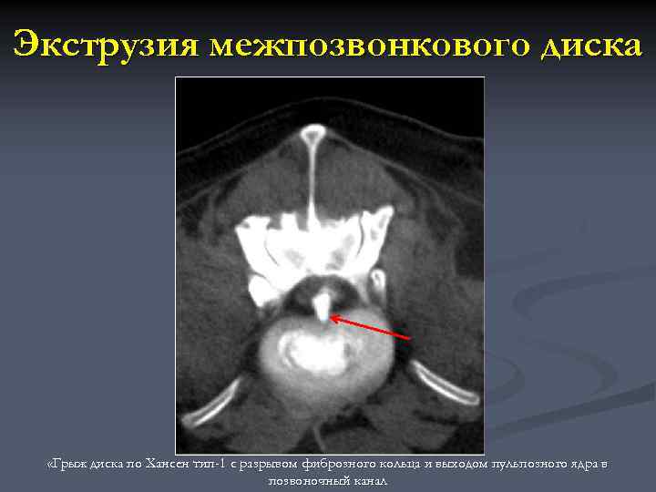 Экструзия межпозвонкового диска «Грыж диска по Хансен тип-1 с разрывом фиброзного кольца и выходом