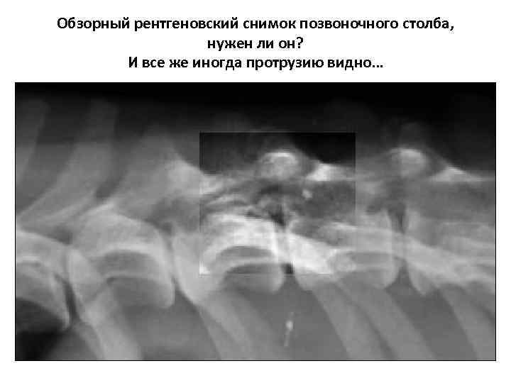 Обзорный рентгеновский снимок позвоночного столба, нужен ли он? И все же иногда протрузию видно…
