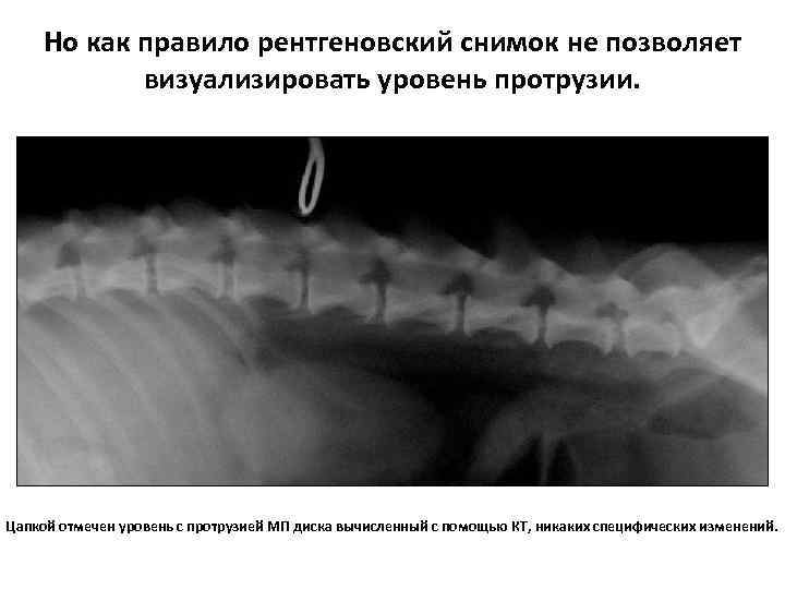 Но как правило рентгеновский снимок не позволяет визуализировать уровень протрузии. Цапкой отмечен уровень с