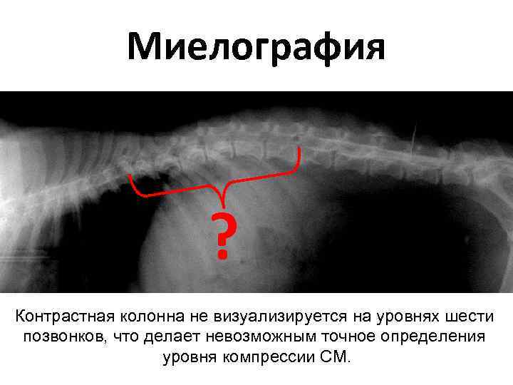 Миелография ? Контрастная колонна не визуализируется на уровнях шести позвонков, что делает невозможным точное