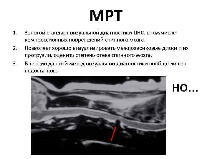 МРТ 1. 2. 3. Золотой стандарт визуальной диагностики ЦНС, в том числе компрессионных повреждений