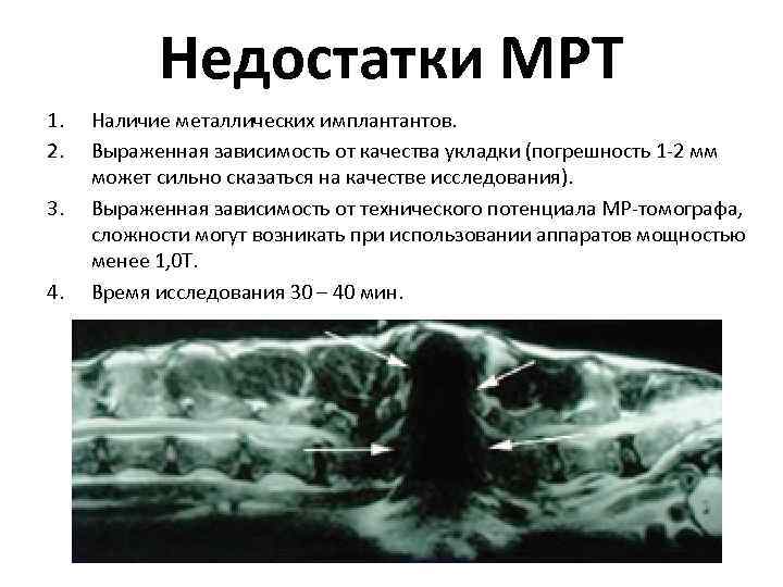 Недостатки МРТ 1. 2. 3. 4. Наличие металлических имплантантов. Выраженная зависимость от качества укладки