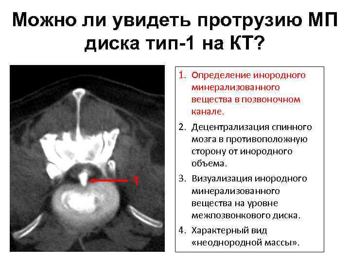 Можно ли увидеть протрузию МП диска тип-1 на КТ? 1 1. Определение инородного минерализованного