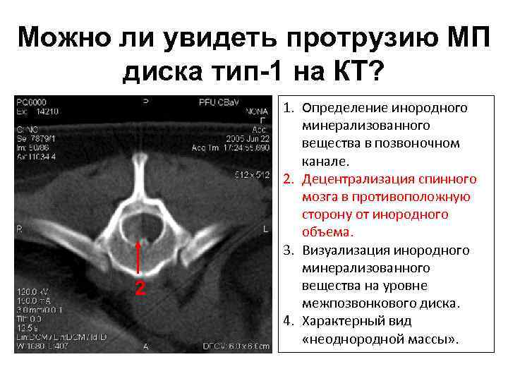 Можно ли увидеть протрузию МП диска тип-1 на КТ? 2 1. Определение инородного минерализованного