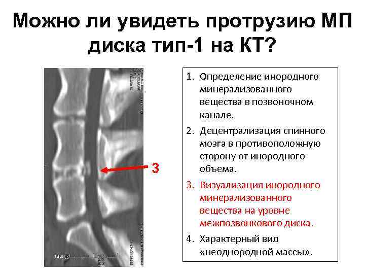 Можно ли увидеть протрузию МП диска тип-1 на КТ? 3 1. Определение инородного минерализованного