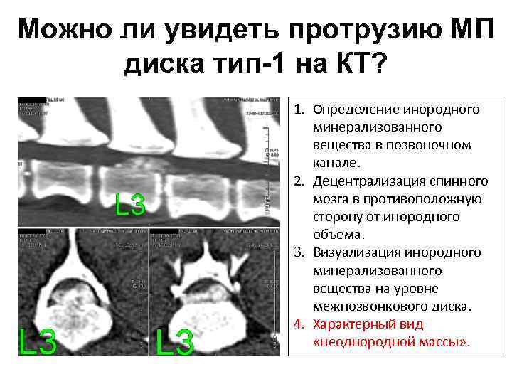 Можно ли увидеть протрузию МП диска тип-1 на КТ? 1. Определение инородного минерализованного вещества