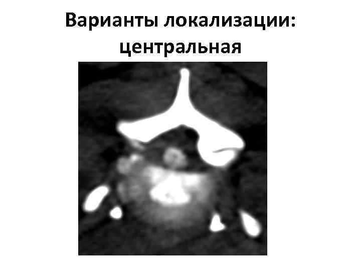 Варианты локализации: центральная 