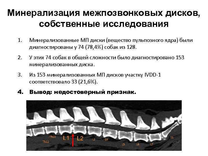 Минерализация межпозвонковых дисков, собственные исследования 1. Минерализованные МП диски (вещество пульпозного ядра) были диагностированы
