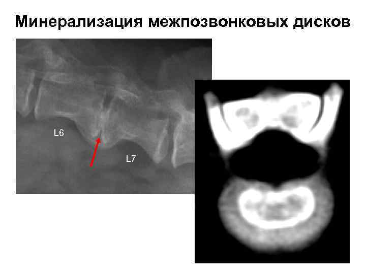 Минерализация межпозвонковых дисков L 6 L 7 