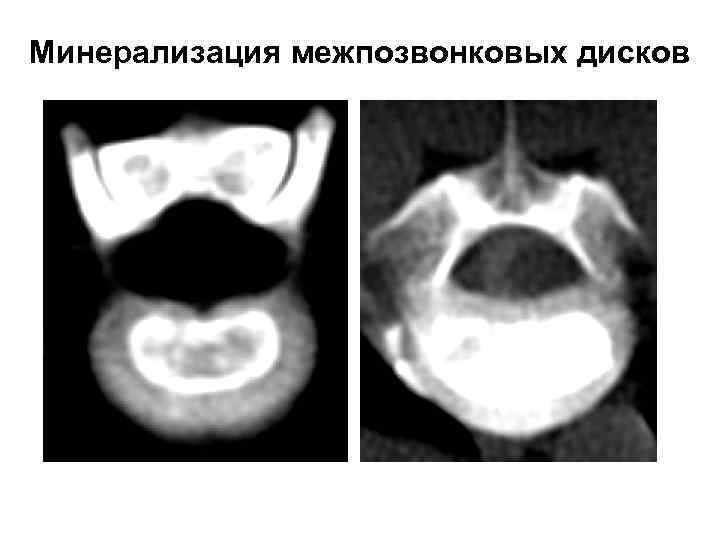 Минерализация межпозвонковых дисков 