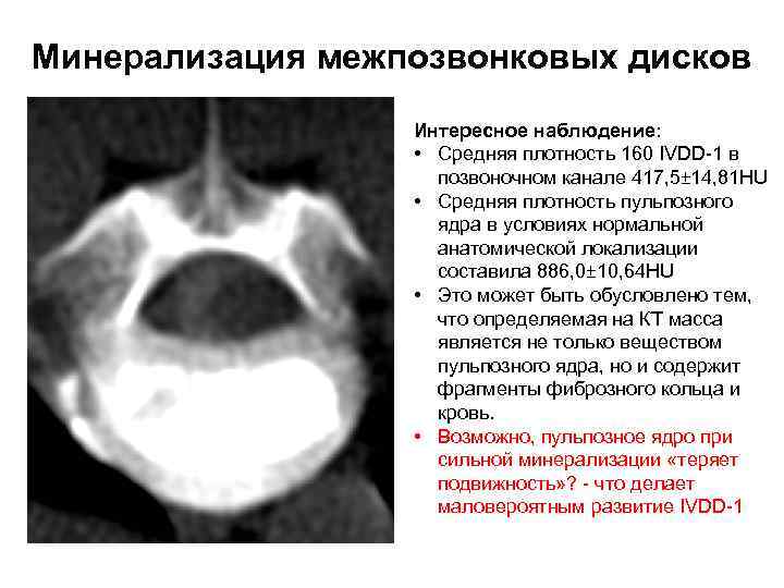 Минерализация межпозвонковых дисков Интересное наблюдение: • Средняя плотность 160 IVDD-1 в позвоночном канале 417,
