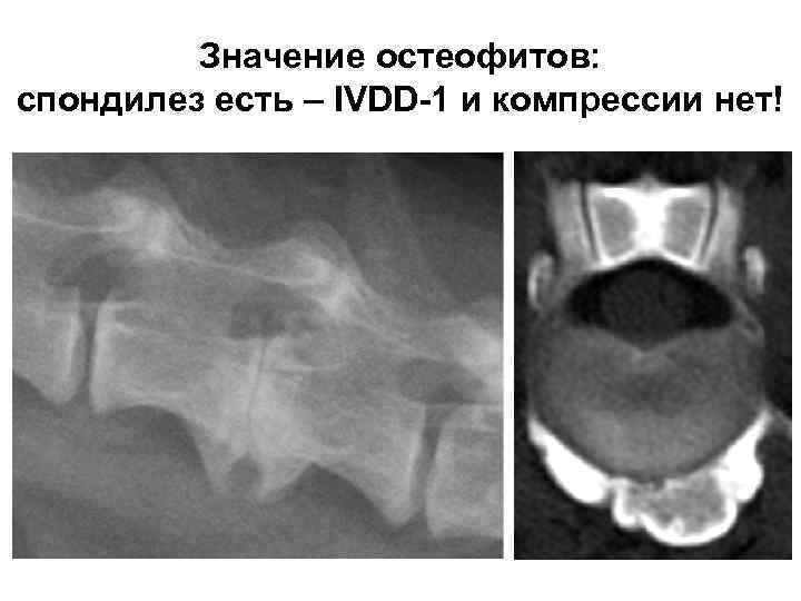 Значение остеофитов: спондилез есть – IVDD-1 и компрессии нет! 